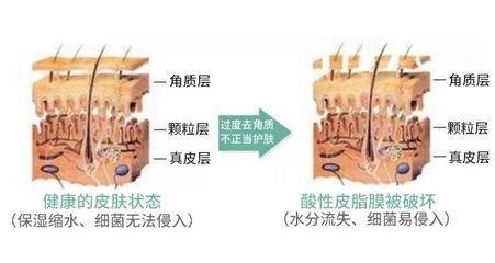 角质层薄可以去角质吗